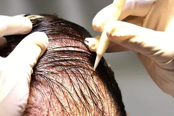 Delhi District Commission Holds DHI Asian Roots Liable For Conducting Hair Transplant Procedures Without Necessary License And Failure To Deliver Satisfactory Results Delhi District Commission Holds DHI Asian Roots Liable For Conducting Hair Transplant Procedures Without Necessary License And Failure To Deliver Satisfactory Results