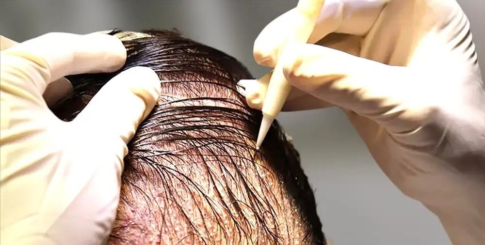 Delhi District Commission Holds DHI Asian Roots Liable For Conducting Hair Transplant Procedures Without Necessary License And Failure To Deliver Satisfactory Results